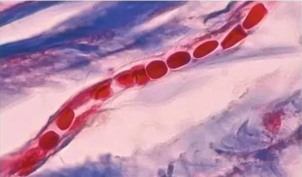 紅血絲形成的原因！