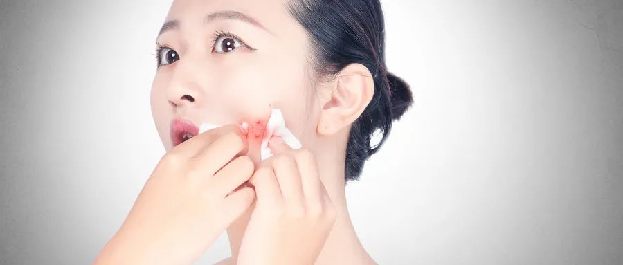 如何預(yù)防粉刺和痤瘡 如何預(yù)防粉刺的發(fā)生和痤瘡的形成?