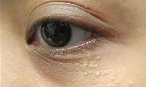 脂肪粒怎么樣才能去除？脂肪粒的去除方法！