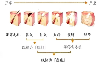 黑頭怎么去除最有效？去除黑頭最有效的方法