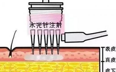 水光針的類型有哪幾種？