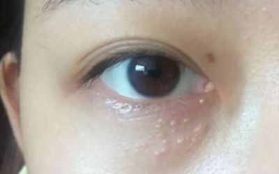 為什么眼部容易長脂肪粒？