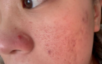 去痘印做什么醫(yī)美項(xiàng)目最好？